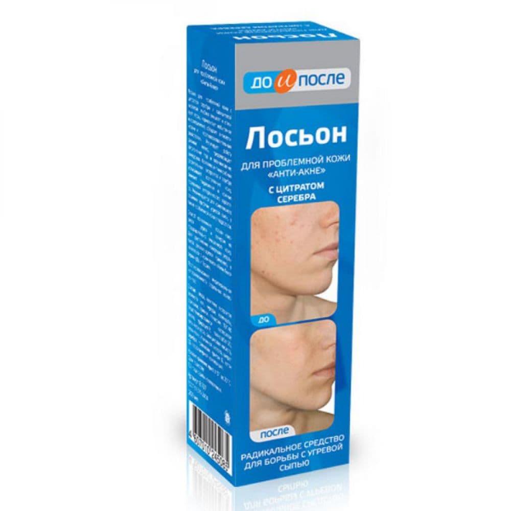До и после лосьон Анти-акне для проблемной кожи